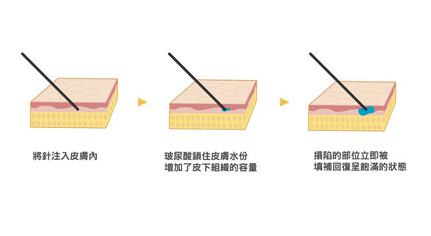 玻尿酸